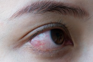 conjunctivitis التهاب الملتحمة